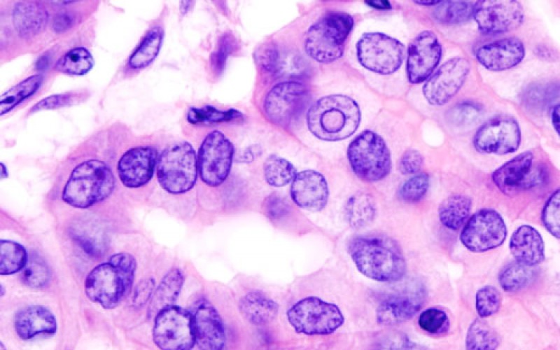 Malignant and possible malignant thyroid tumor in Fukushima children became “104”