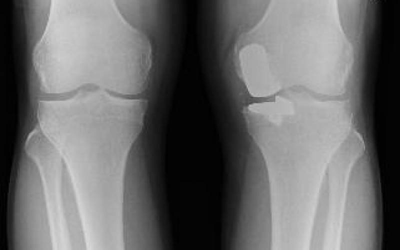 Google trend shows “Joint hurts” is searched increasingly since 2011 in Japan / Sr-90 accumulates in bone